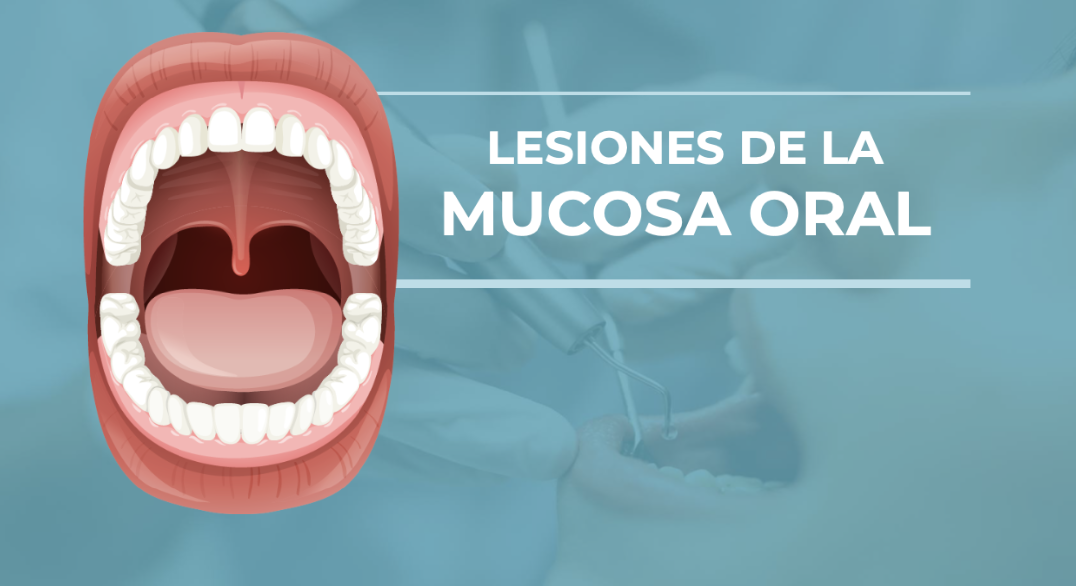 Lesiones de la Mucosa Bucal